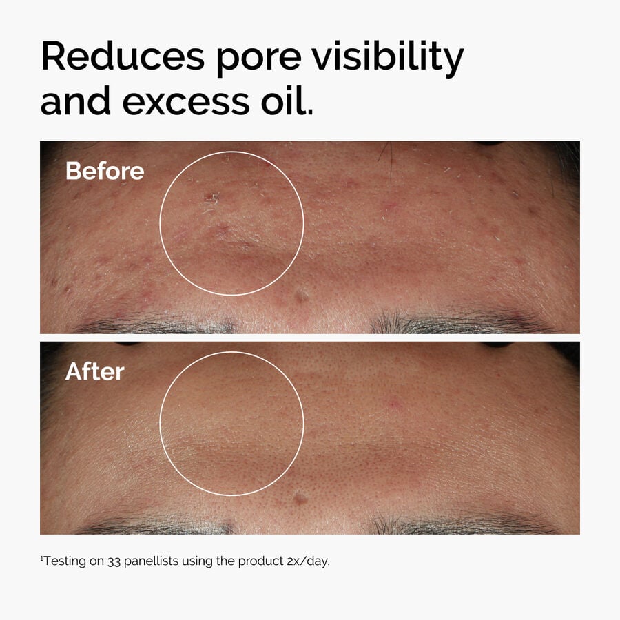 niacinamide-10-zinc-1-t0 ord-niacinamide-zinc-blemish-serum-before-after-pores.jpg