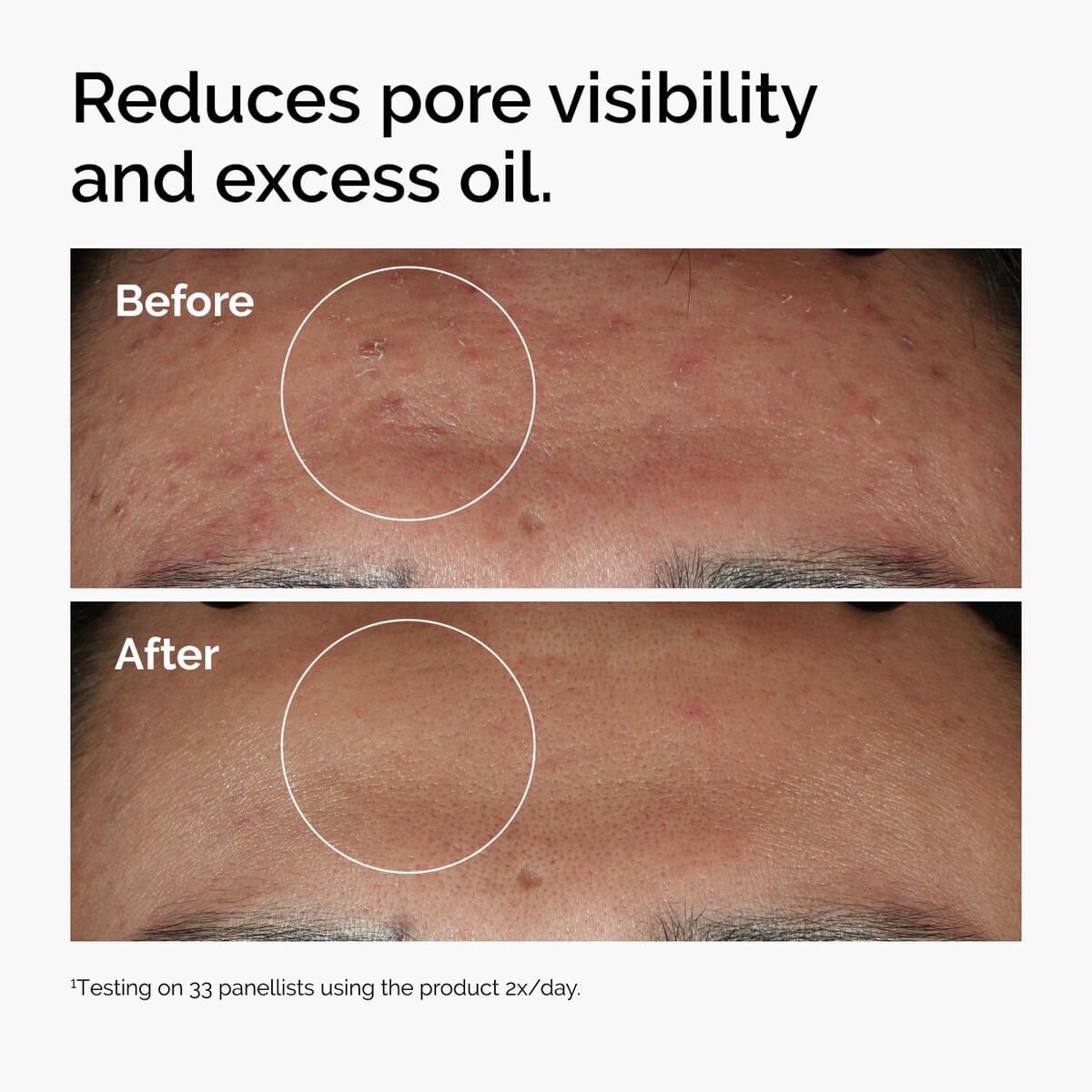 niacinamide-10-zinc-1-t0 ord-niacinamide-zinc-blemish-serum-before-after-pores.jpg