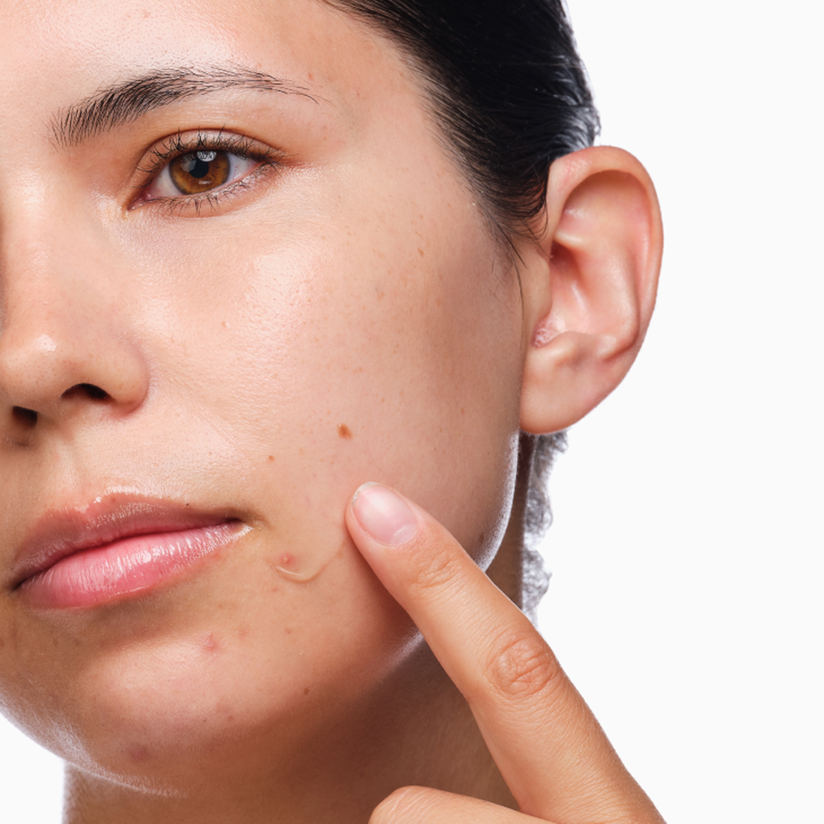 the-acne-set-e8 rdn-the-acne-set-application.png